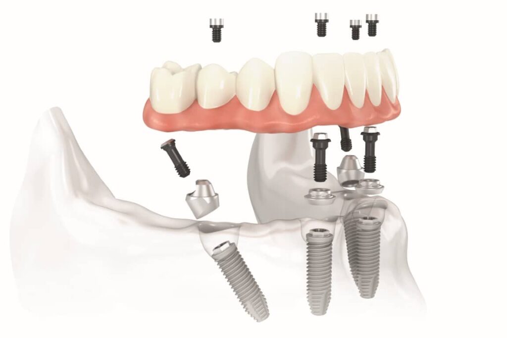All-on-4 prosthesis
