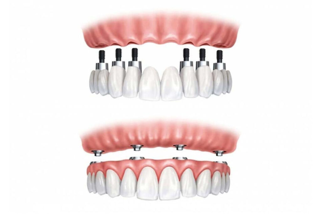 All-on-4-6-8 prosthesis