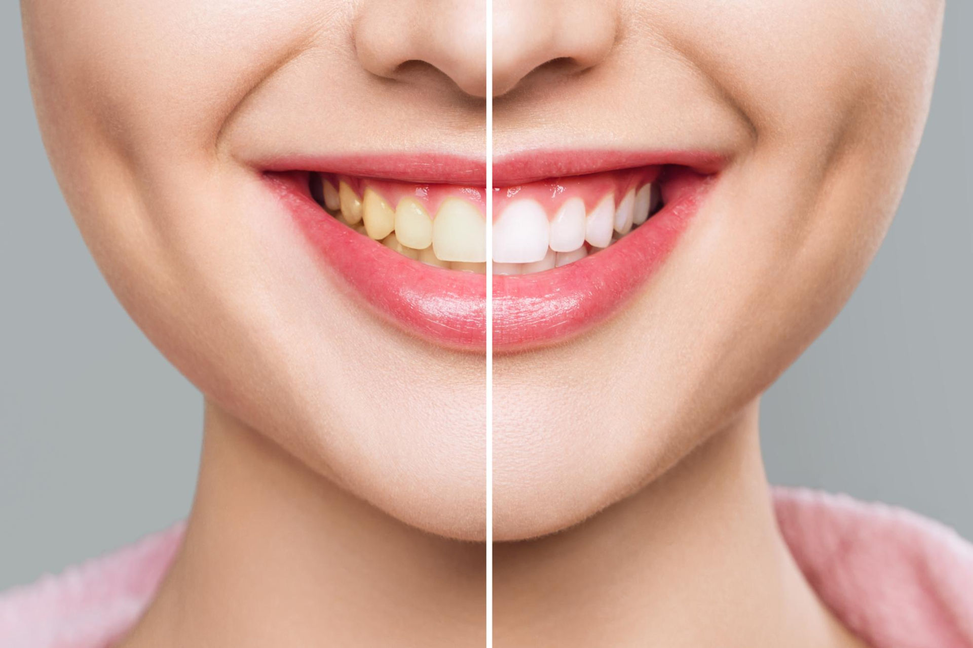 Teeth withening