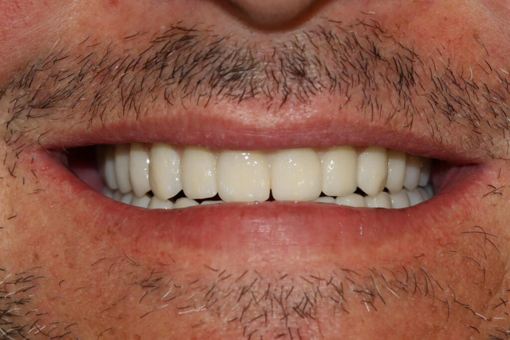 All-on-6 prosthesis